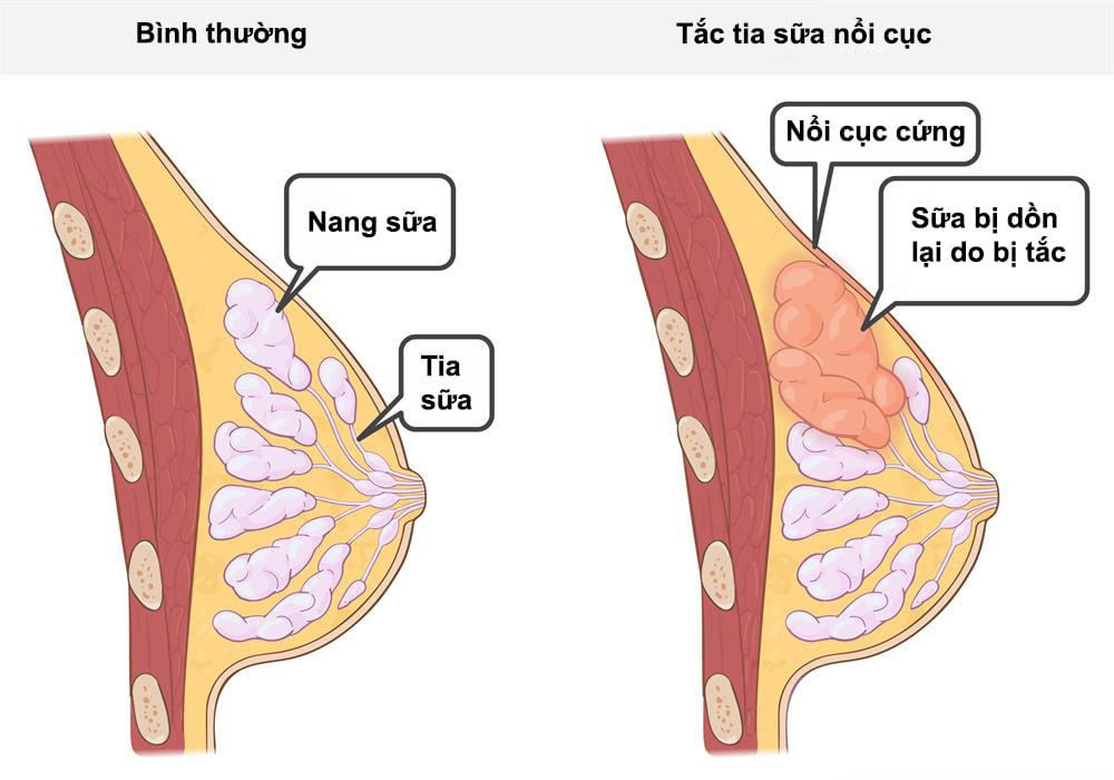 Tắc tia sữa là hiện tượng rất dễ gặp phải trong quá trình nuôi con bằng sữa mẹ